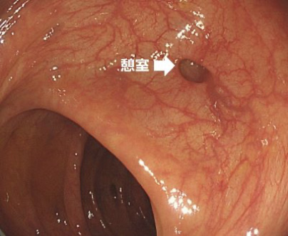 大腸憩室症の疾患イメージ