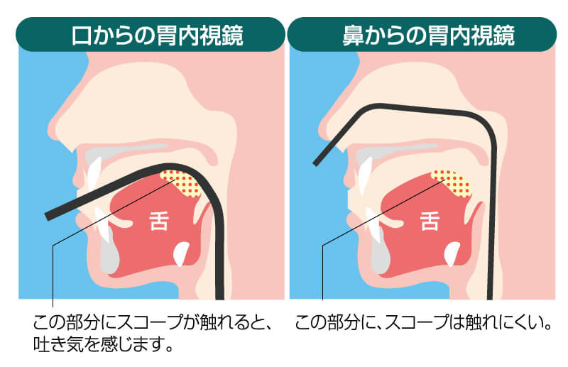 胃カメラ検査のイメージ