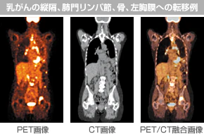 PET/CT画像イメージ