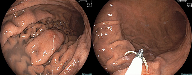 胃アニサキス症（胃カメラ画像）