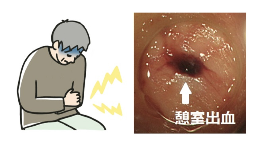 大腸憩室症の原因・症状イメージ