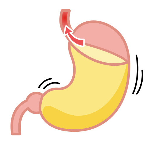 胃食道逆流症イメージ
