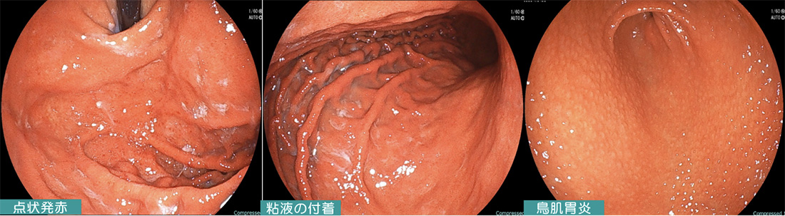 ピロリ感染胃炎（胃カメラ画像）